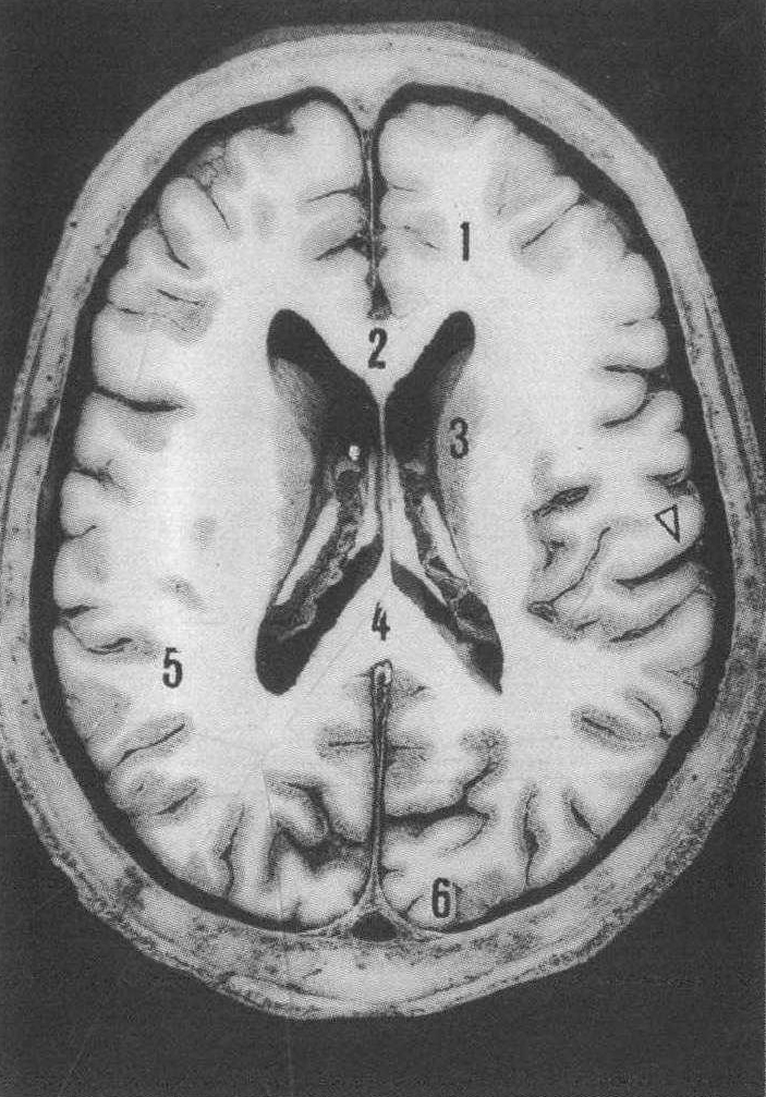侧脑室体部水平轴位切面人体标本图